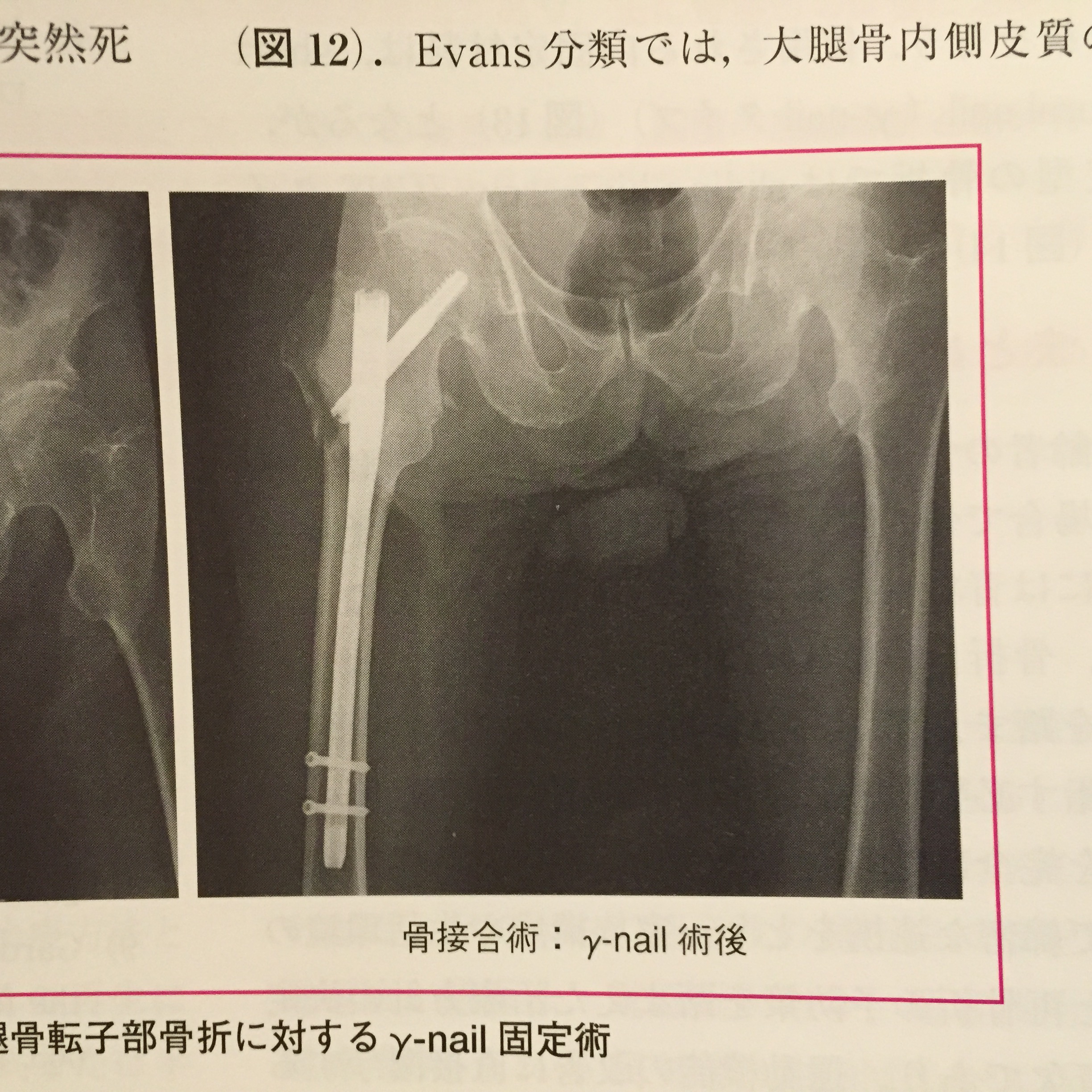 大腿骨近位部骨折について｜松山市救急指定病院 医療法人ミネルワ会 渡辺病院